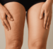 Cellulite e ritenzione idrica: scopri l’equivoco della “buccia d’arancia”